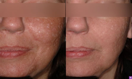 五次微波後的小腹