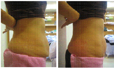 五次微波後的小腹