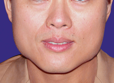 打針前(只打了一次) 