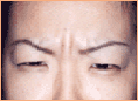 肉毒桿菌除皺眉紋