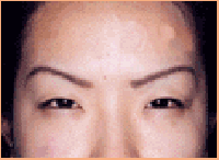 肉毒桿菌除皺眉紋