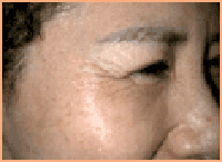 肉毒桿菌除魚尾紋