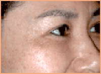 肉毒桿菌除魚尾紋