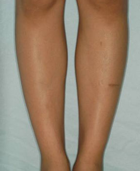 正面注射後六個月