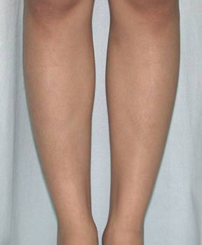 正面注射後九個月