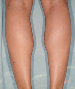 背面注射後六個月