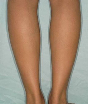 背面注射後九個月